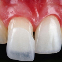 Fındıkzade İmplant Tedavisi & 34 Dental Klinik