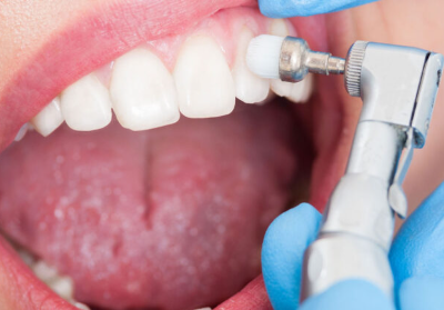 ŞANLIURFA Diş Taşı Temizliği